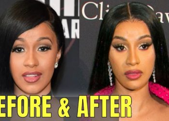 Cardi B: Plastic and Cosmetic Surgery