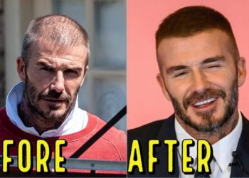 DAVID BECKHAM'S AMAZING HAIR LOSS TRANSFORMATION! DID HE GET A HAIR TRANSPLANT?